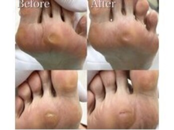 巻き爪補正店 札幌店/ 【【硬いタコ/魚の目ケア】