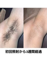 美意識/ ほぼ痛みなし♪