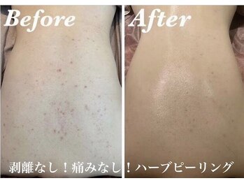 ルアナアイナ(Luana Aina)/背中ケア/ハーブピーリング