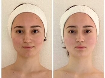 ル シエル(Le Ciel)/20代/一度の施術左before右after