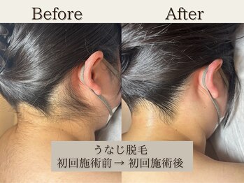 インベスト(INVEST)/うなじ脱毛