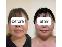 ムクミ・お肌の悩みも一緒に改善！小顔&潤肌が一緒に手に入る◎