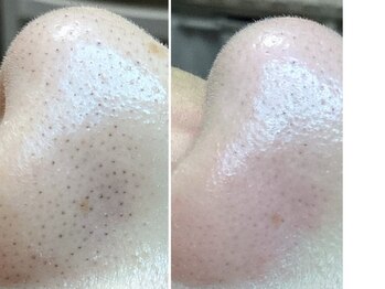 美肌プロジェクト カーラ 東川口店(CARA)/毛穴エクストラクション認定店