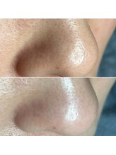 エヌ ドット ジュウイチ(N.11)/黒ずみ毛穴洗浄