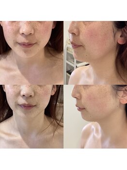 ビューティーサロン セガール(segar)/レモンボトルフェイス