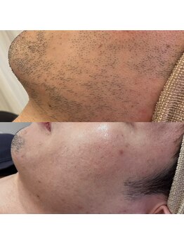 ブリリア(Brillia)/脱・青髭で清潔感UP