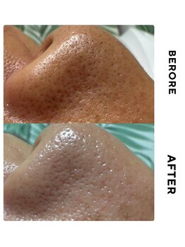 ゼロ(ZERO)/フェイシャル☆毛穴洗浄