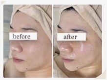 エムイーボーテ(me.Beaute)の雰囲気（1度で劇的変化。小顔＆リフトアップ◎横顔の印象が変わります。）