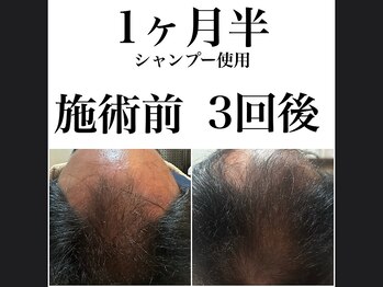 キュライム 熊本(CURAIM)/育毛促進 【60代男性】