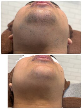 サロン ルアナ(salon luana)の写真/【メンズ人気NO.1ヒゲ脱毛】初回は3150円◎デザインで残したい部分は残せます！