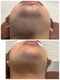 サロン ルアナ(salon luana)の写真/【メンズ人気NO.1ヒゲ脱毛】初回は3150円◎デザインで残したい部分は残せます！