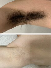 エアリアル 大川店/メンズワキ脱毛