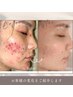 【剥離あり】ハーブピーリング◆ニキビケア◆お悩み深い方￥55000→￥22000