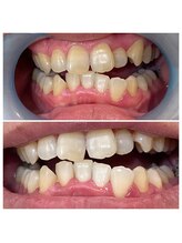 ウルト(ULT)/セルフホワイトニング