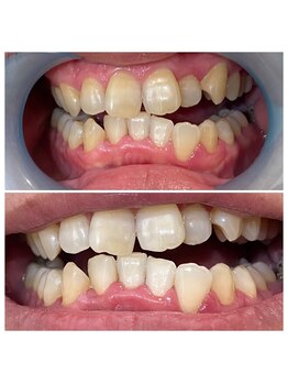 ウルト(ULT)/セルフホワイトニング