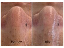 ハリスキンラボ(Hari.Skin.Lab)/40代のお客様/2回目の毛穴コース