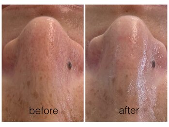 ハリスキンラボ(Hari.Skin.Lab)/40代のお客様/2回目の毛穴コース