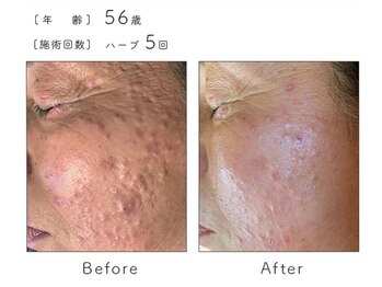 チップ(chip)/56歳/施術5回