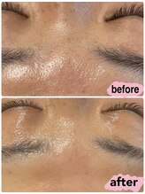 アムール(Amour)/wax＋BBLスーパー光フェイシャル