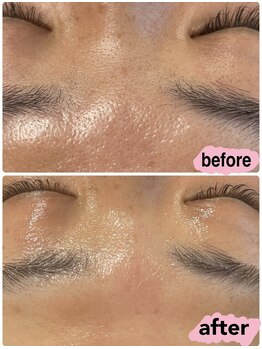 アムール(Amour)/wax+BBLスーパー光フェイシャル