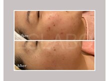 エスラボ オオサカ 心斎橋/剥離ありハーブピーリング