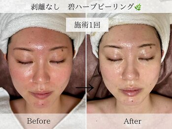 フラリ 西葛西(Hulali)/【30代】ハーブピーリング1回目