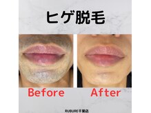 ルブレ 千葉(RUBURE)の雰囲気（メンズ脱毛ヒゲ　ビフォーアフター　通常価格　１回　6,000円）