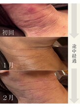 アーブル(Agreable)/赤ら顔/乾燥/血行不良/疲労
