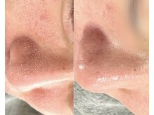 リリー(RILY)/【毛穴洗浄ビフォーアフター】