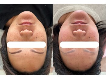 ナンバーナイン(No.9)/結果にこだわるシミケア