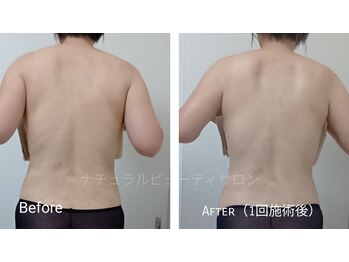 ナチュラルビューティサロン/背中すっきり！1回でも実感！？