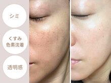 エヌプラスビューティー(N+beauty)の雰囲気（難しいモヤモヤシミにも継続することで内側からキレイに！）