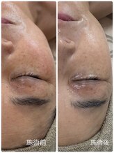 リノ(LINO)/フェイシャルケア“セルマン”