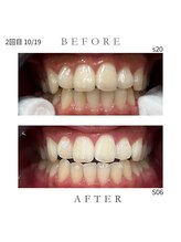 エンルーチェ プラスエイト(en;Luce+8)/ホワイトニング　2回