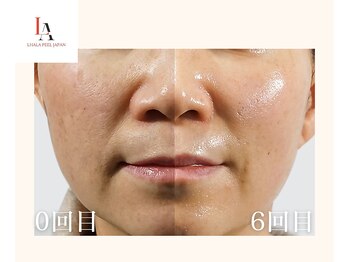 ウィウィ(oui-oui `)/肌育ララピール