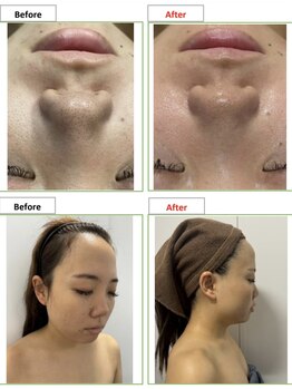 エステティック レイビス 銀座店(RAYVIS)/before＆after