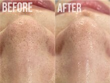 煌(kirameki)/毛穴洗浄/水素ハイドロ