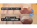 巻き爪の痛みを楽にしたい方へ