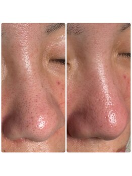 サイセイ(SAISEI)/毛穴洗浄後は鎮静もしっかりと!