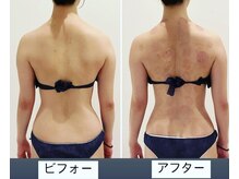 TMサロン 赤坂/もっこり肩解消！