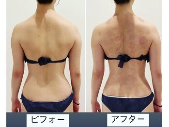 TMサロン 赤坂/もっこり肩解消！