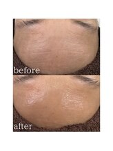 ビレイナ(BIREINA)/＊カーボキシー炭酸パック＊