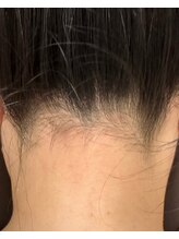 ヒーリングハーツ(Healing Hearts)/うなじ美人/清水町/脱毛/エステ/