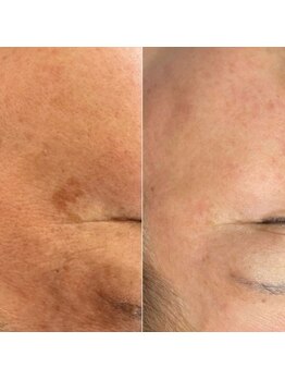 ジン フォー ユアビューティー(JIN for your beauty)/施術経過