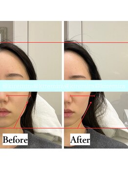 キレミラ 麻布十番店/リフトアップBefore/After(3)