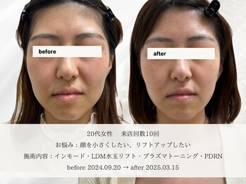 エメ(aimer)/LiftCare《小顔・リフトアップ》