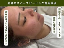 アンテサロン 関内店(Antesalon)/剥離施術後の肌の赤みの状態