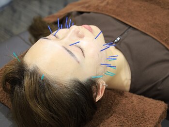 リベルタ鍼灸整骨院 新宿院(Liberta鍼灸整骨院)/翌朝スッキリ！小顔美容鍼