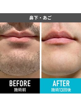 RBL 三重四日市店/メンズ脱毛／ヒゲ脱毛13回目