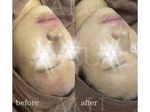 アルフォービューティー 恵比寿店(ALU for beauty)/赤み・揺らぎ症例